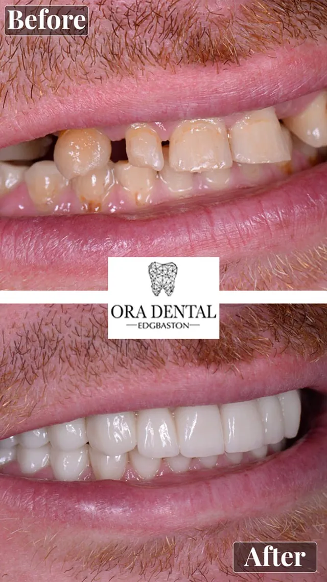Before & After Ora Dental