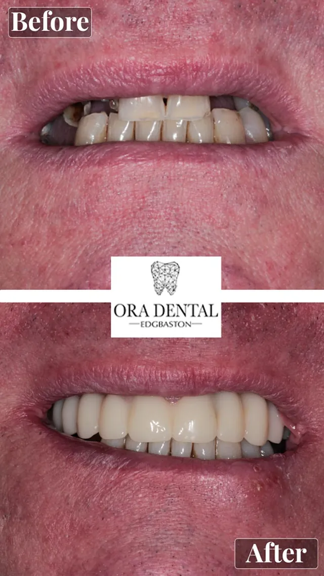 Before & After Ora Dental