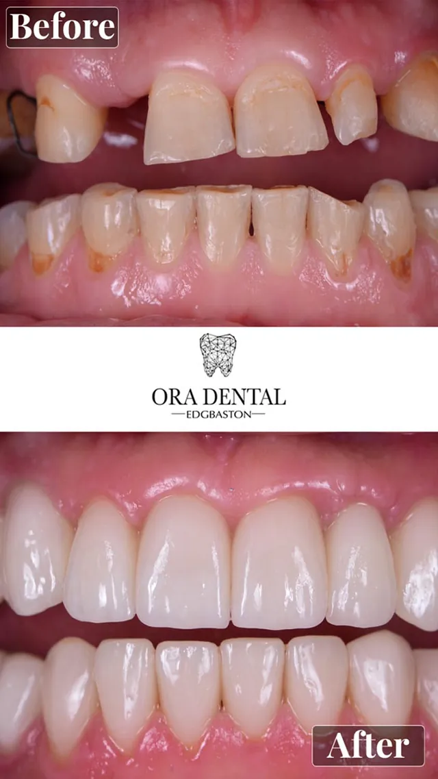 Before & After Ora Dental