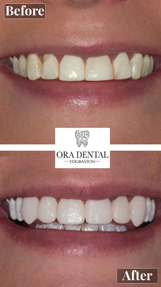 Before & After Ora Dental